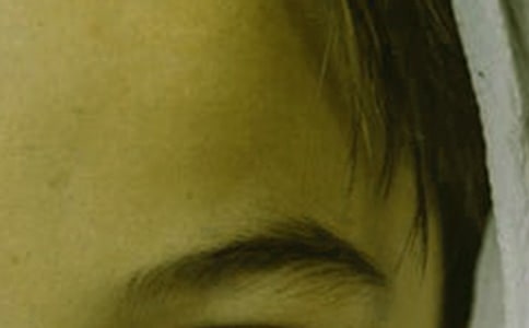 眉毛里長痘痘的原因