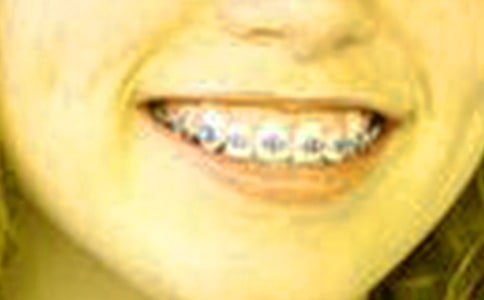 取牙套初中生作文(精選16篇)