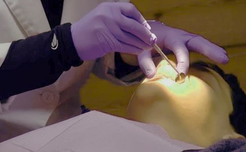 無痛微創技術在下頜阻生智齒拔除術中的臨床應用